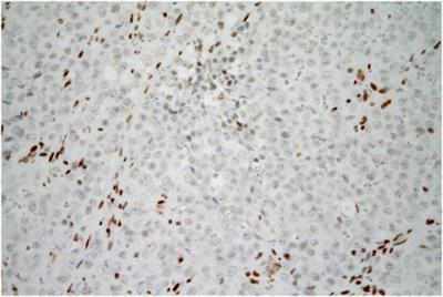 SMARCA4-Deficient Carcinoma of Uterine Cervix Resembling SCCOHT—Case Report